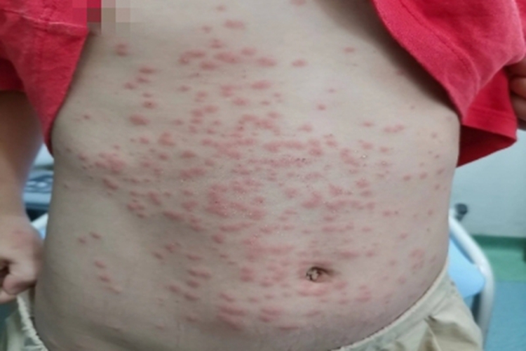 昆虫性皮炎腹部丘疹图