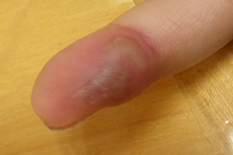 脓性指头炎手指水疱图