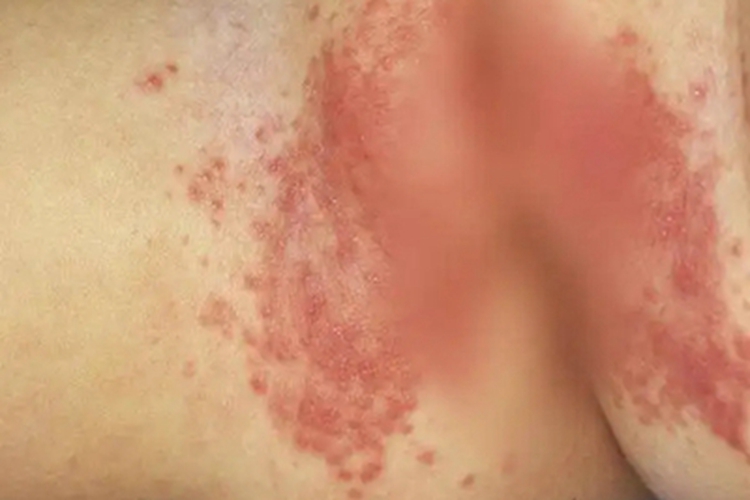 肛周接触性皮炎肛周水疱图