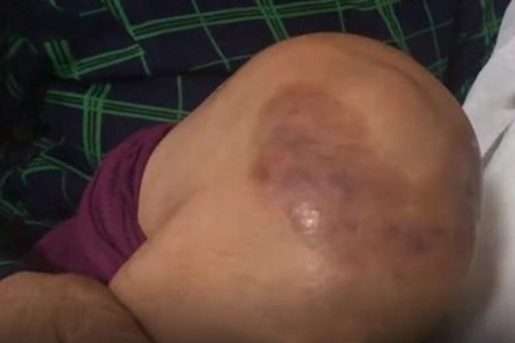 皮肤非典型分枝杆菌病膝盖结节图