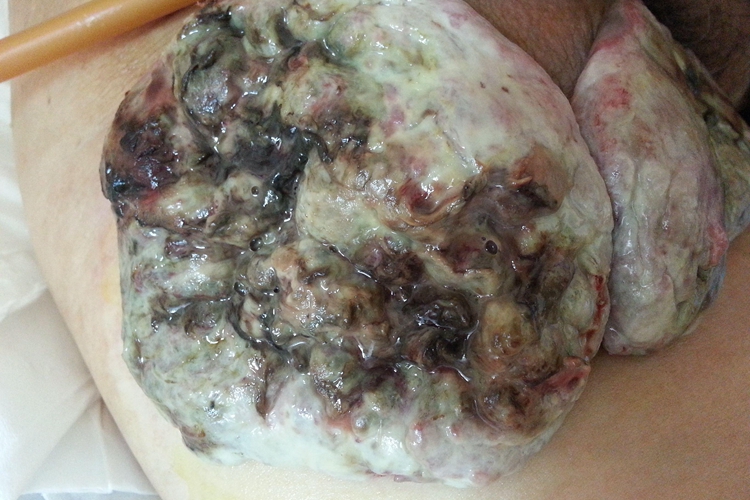 恶性黑色素瘤破溃出血图