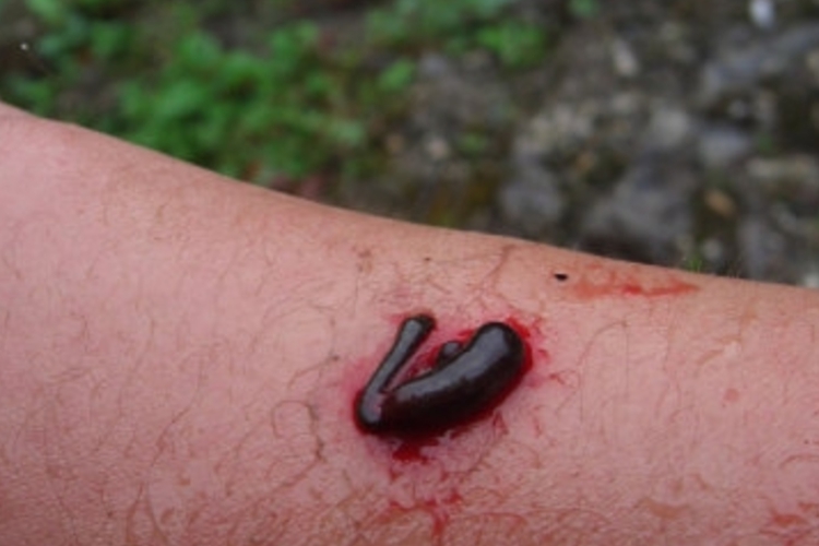 被水蛭咬了出血图 被水蛭咬了出血图