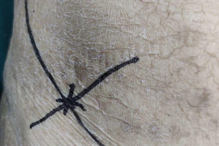 腰大肌深部脓肿凹陷水肿图