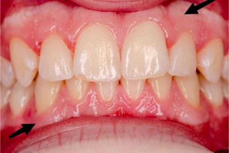 局限型侵袭性牙周炎白斑图 局限型侵袭性牙周炎白斑图