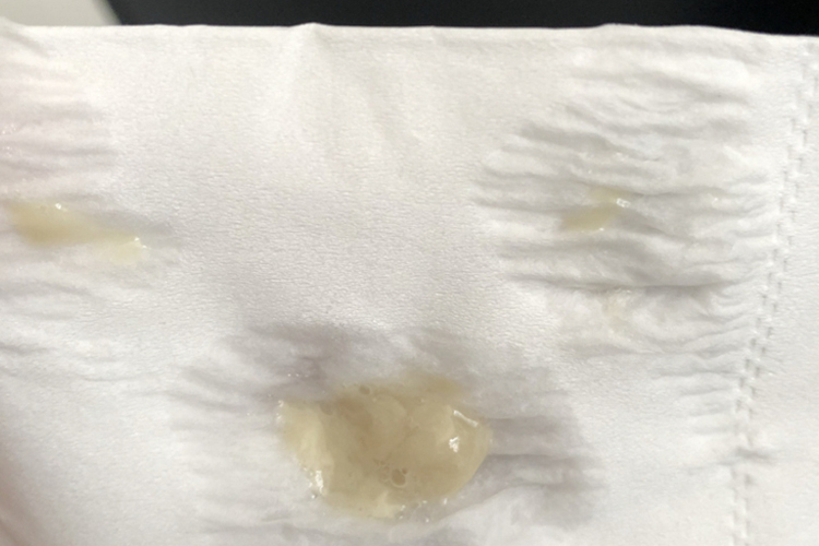 慢性咽炎咳出小坨凝固的痰图