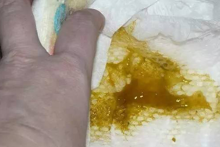 肠易激综合征胶冻样便图