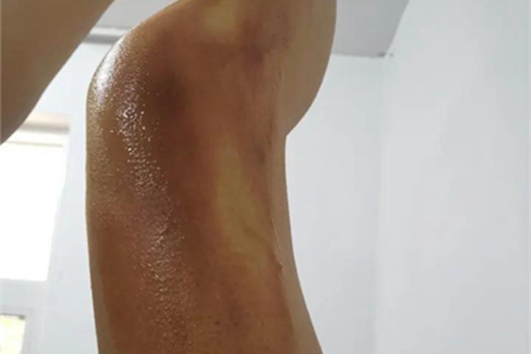 一度烫伤大腿症状图
