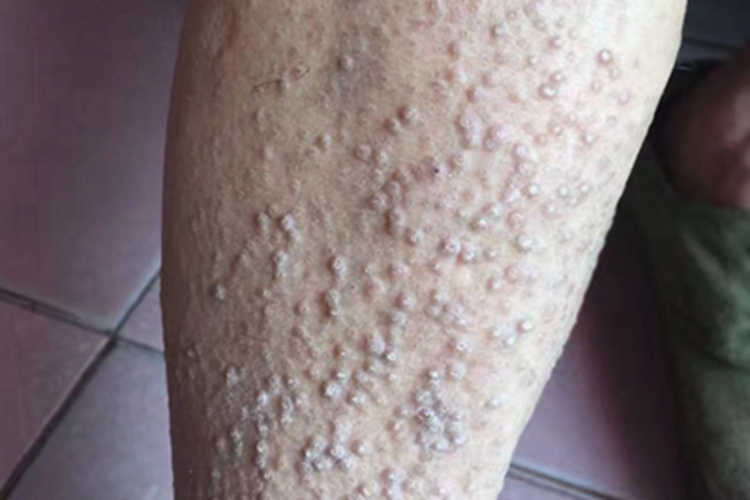 皮肤淀粉样变小腿症状图 皮肤淀粉样变小腿症状图