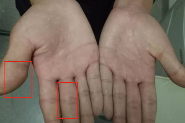 腱鞘巨细胞瘤变形图