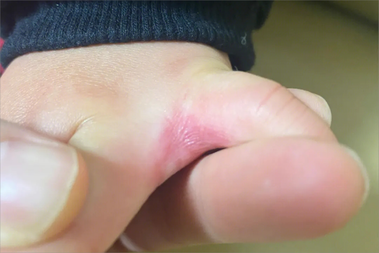 接触性皮炎手指缝症状图