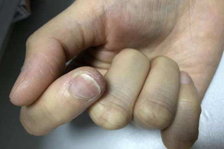 缺铁性贫血手指甲变薄图