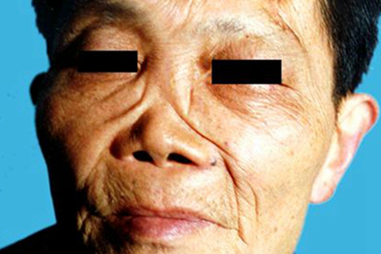 女性梅毒变形图