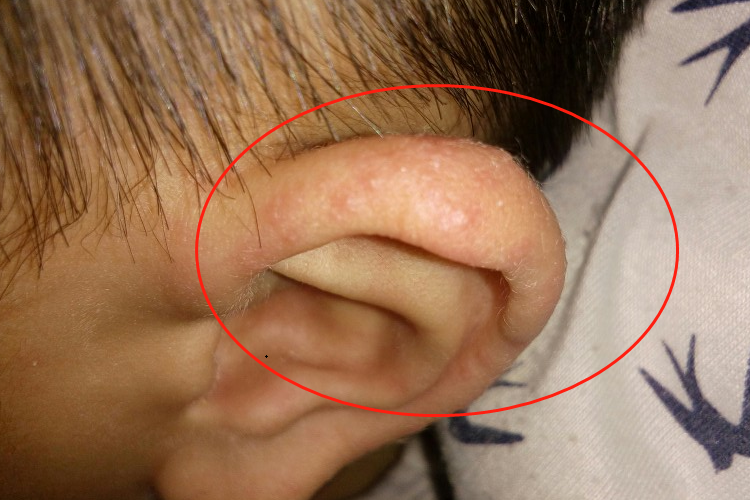 湿疹耳朵红点图