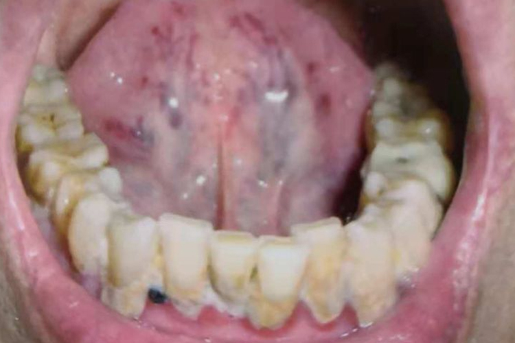 舌下络脉瘀血图