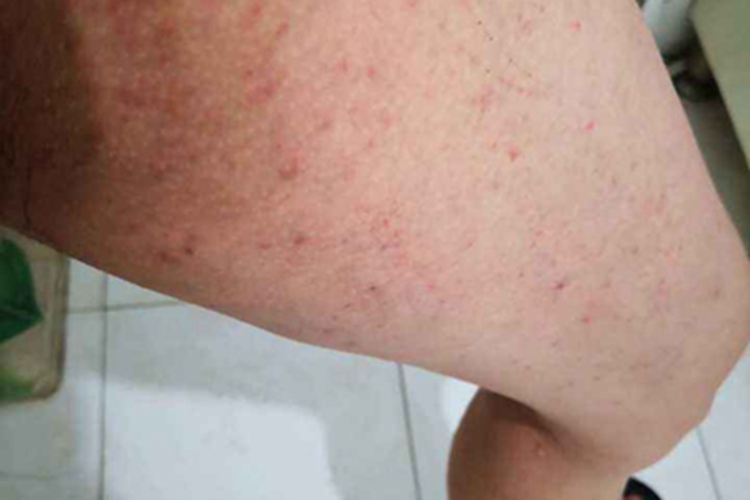 疥疮腿丘疹图 疥疮腿丘疹图