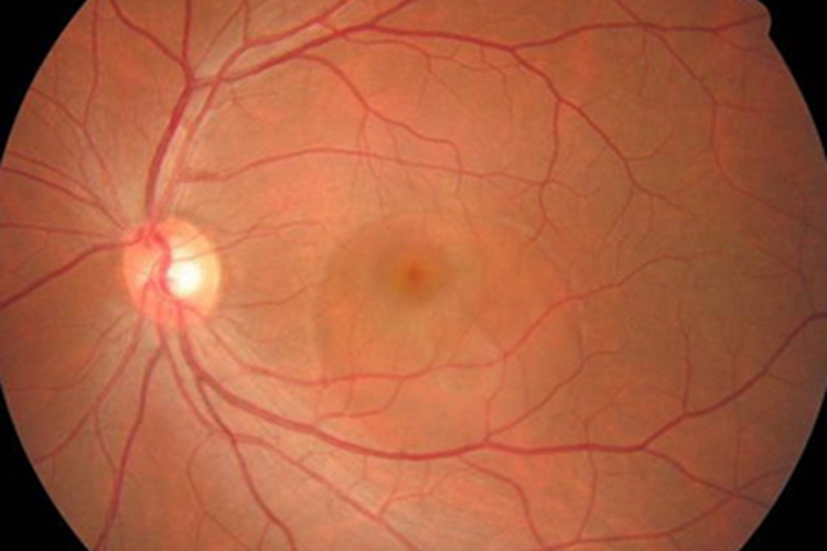 视网膜脉络膜炎黄斑区水肿图 视网膜脉络膜炎黄斑区水肿图