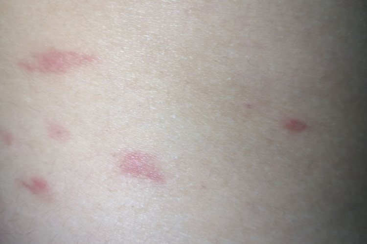 臭虫叮咬丘疹图