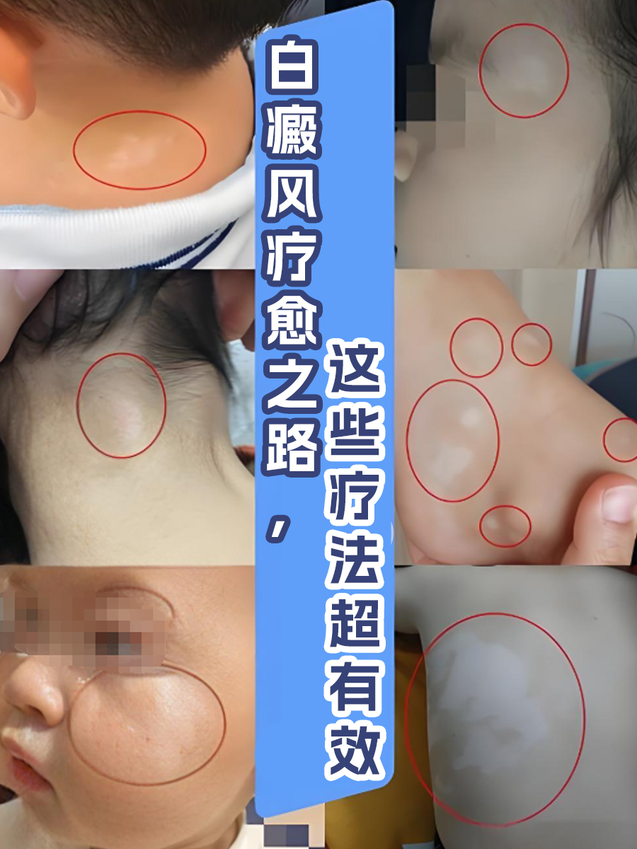 白癜风疗愈之路,这些疗法超有效