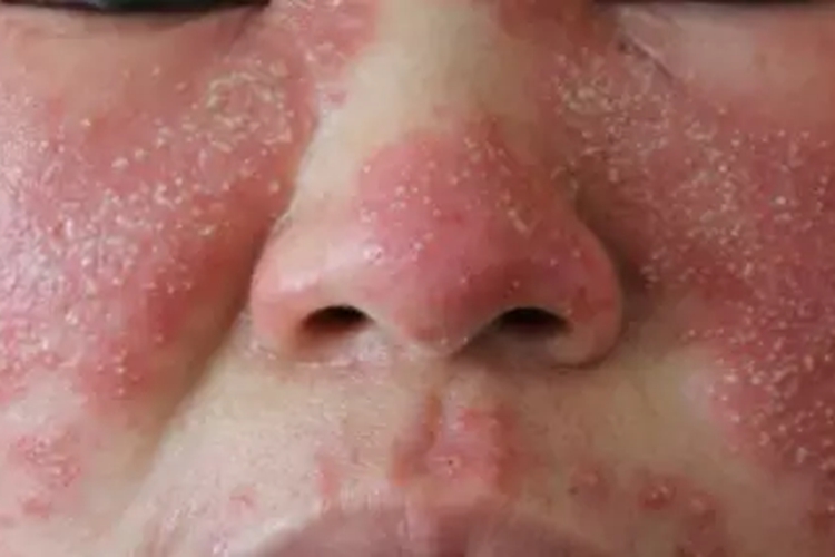 寻常狼疮面部脱屑图片