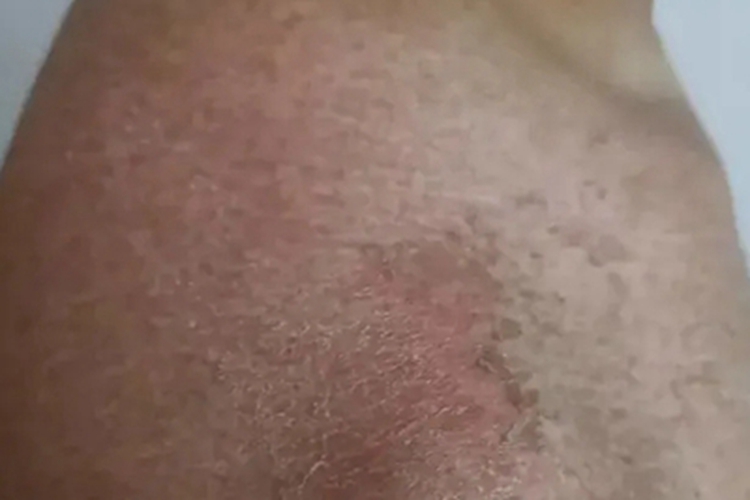 日照性皮炎肩部斑图