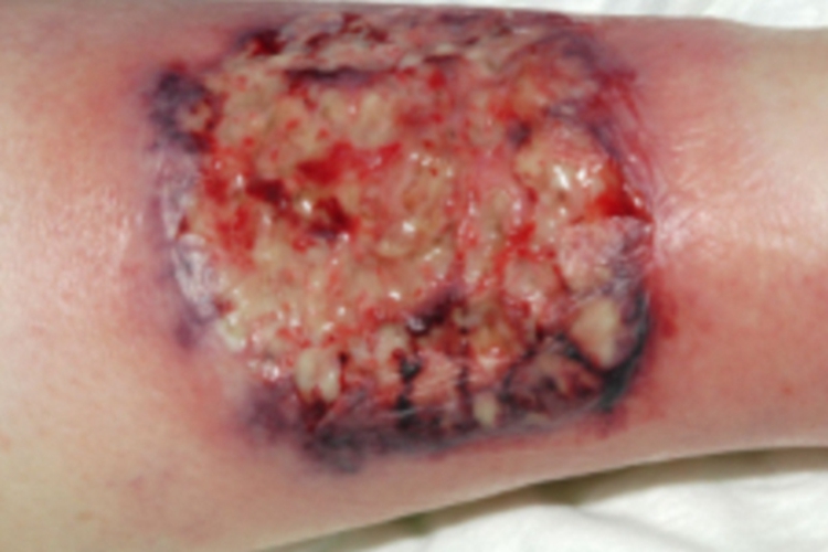 费尔蒂综合征小腿溃疡症状图 费尔蒂综合征小腿溃疡症状图