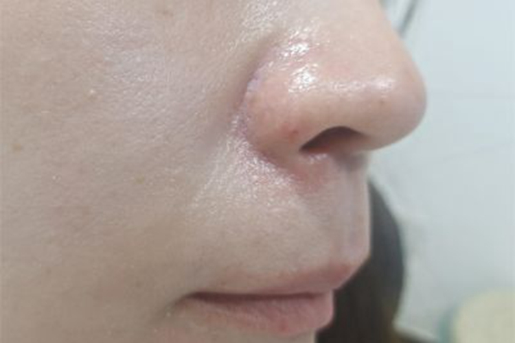 脂溢性皮炎鼻翼症状图