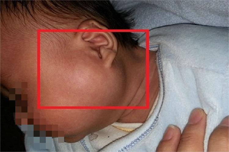 急性化脓性腮腺炎症状图