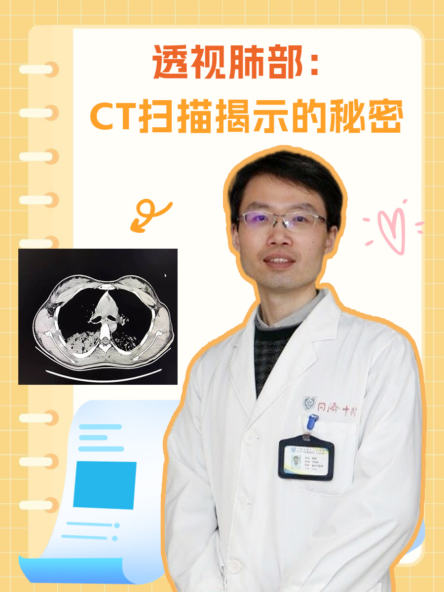 透视肺部:CT扫描揭示的秘密