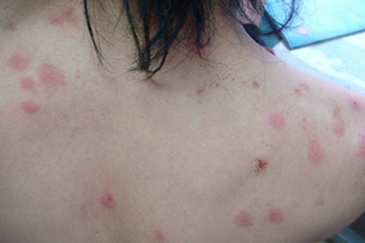 恙螨皮炎肩部小红疙瘩图