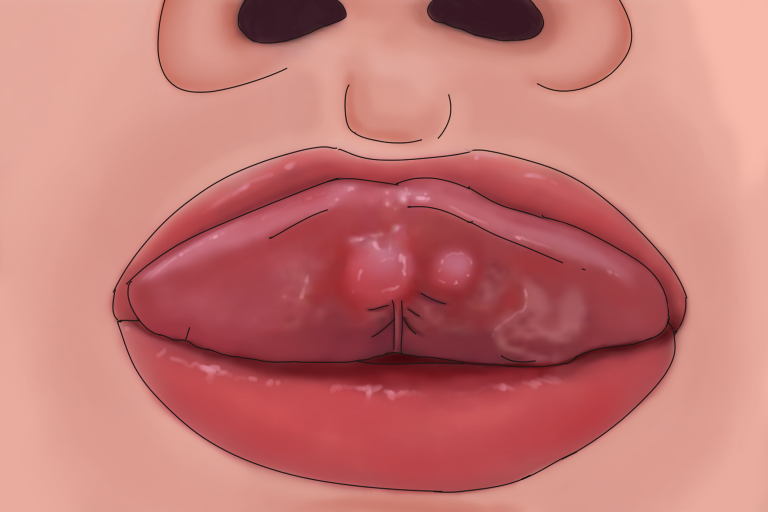 舌前腺囊肿舌尖有疱图 舌前腺囊肿舌尖有疱图