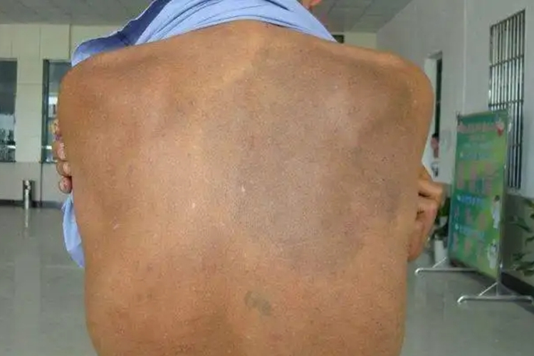 黑变病图 黑变病图