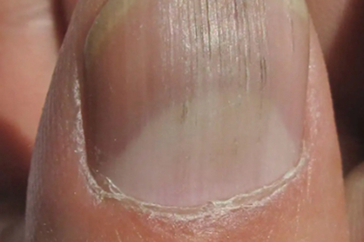 甲纵裂指甲有竖纹图