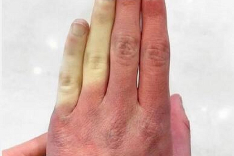 雷诺病手部症状图 雷诺病手部症状图