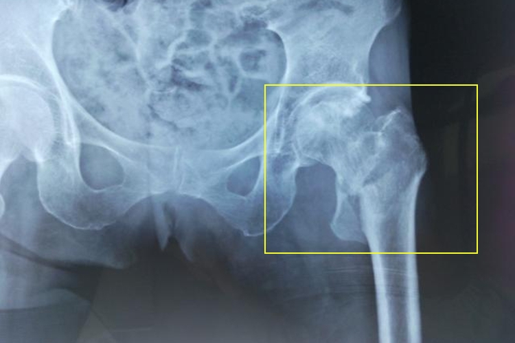 左股骨粗隆间骨折X线图