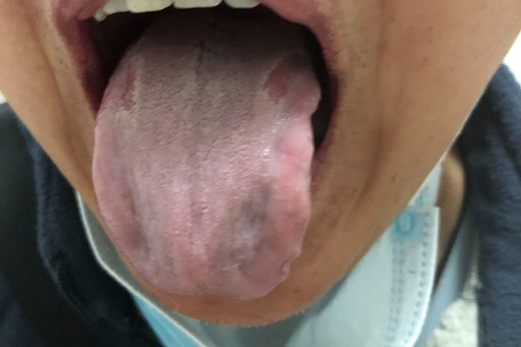 肝气犯胃证的舌象图