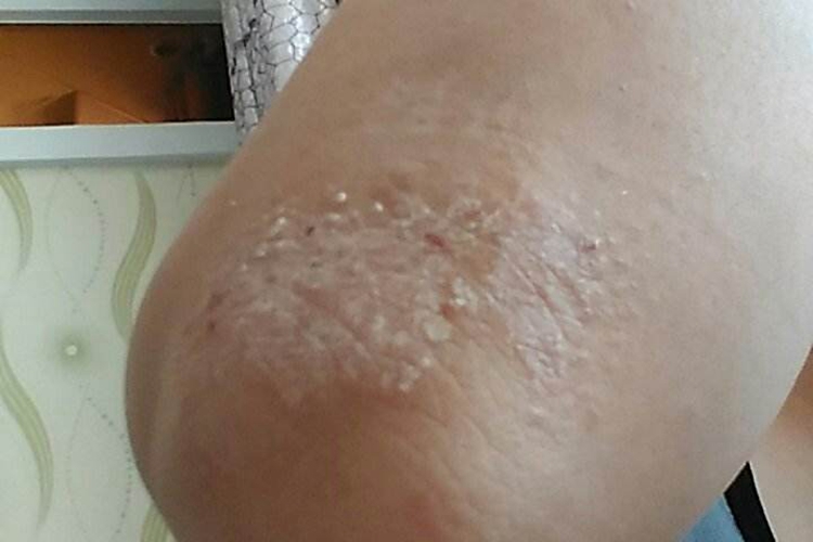 胳膊肘关节体癣图