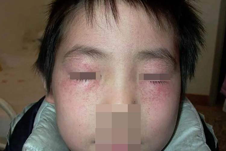 机械性紫癜眼窝发紫图