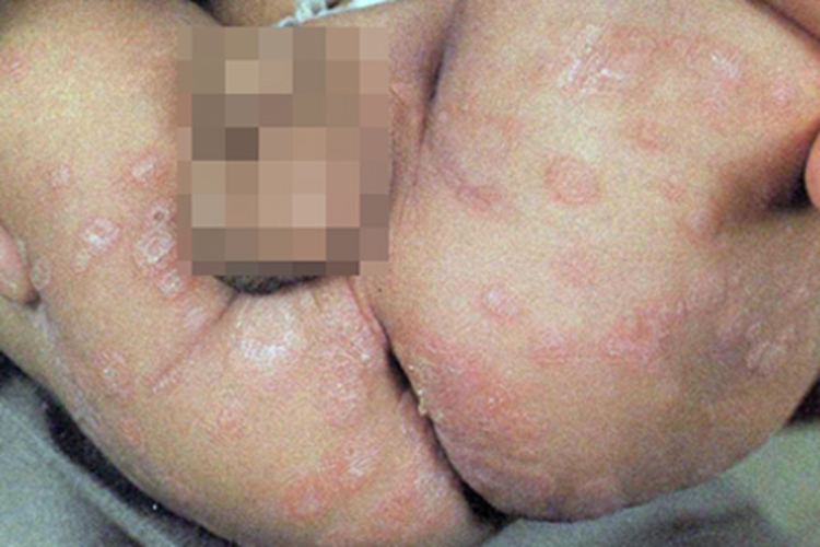 先天性梅毒臀部红斑脱屑图 先天性梅毒臀部红斑脱屑图