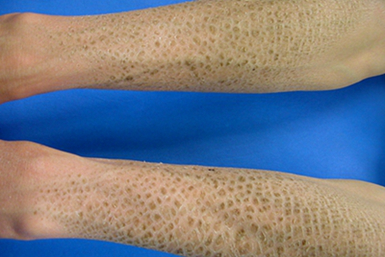 鱼鳞病胳膊症状图