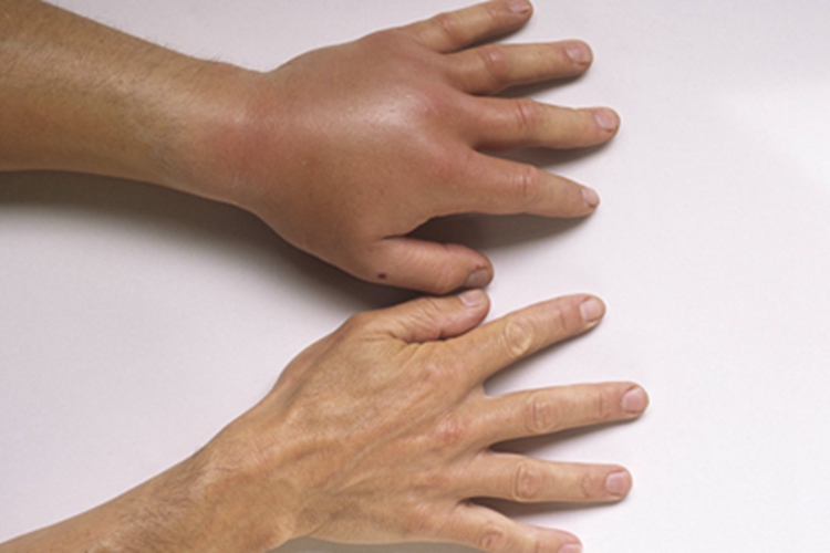 茶毛虫皮炎左手背肿胀图