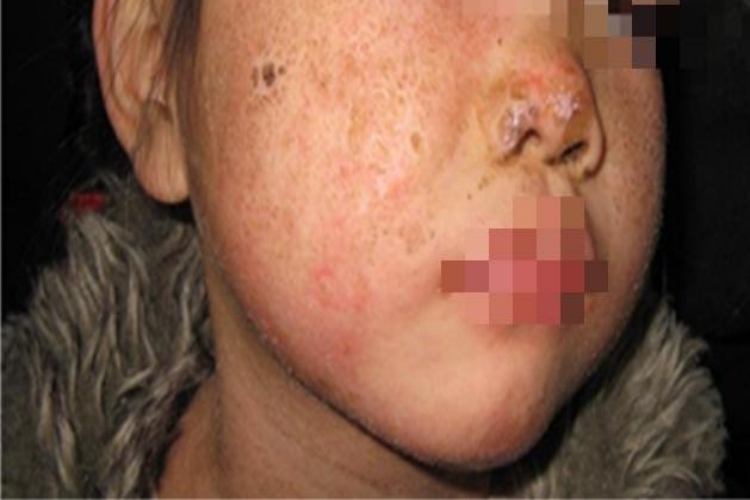 脓疱病焦痂图 脓疱病焦痂图