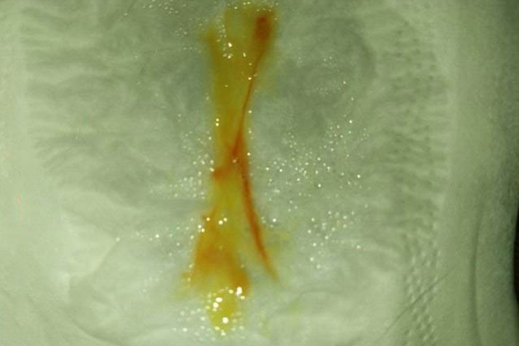 急性鼻窦炎脓涕带血图