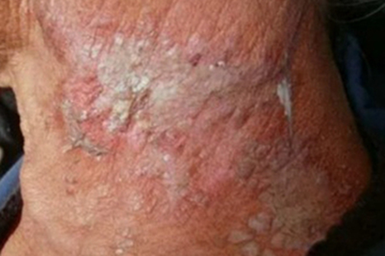 隐翅虫皮炎后颈糜烂图