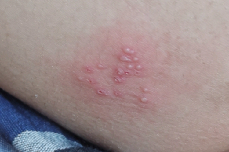 单纯疱疹大腿水疱图