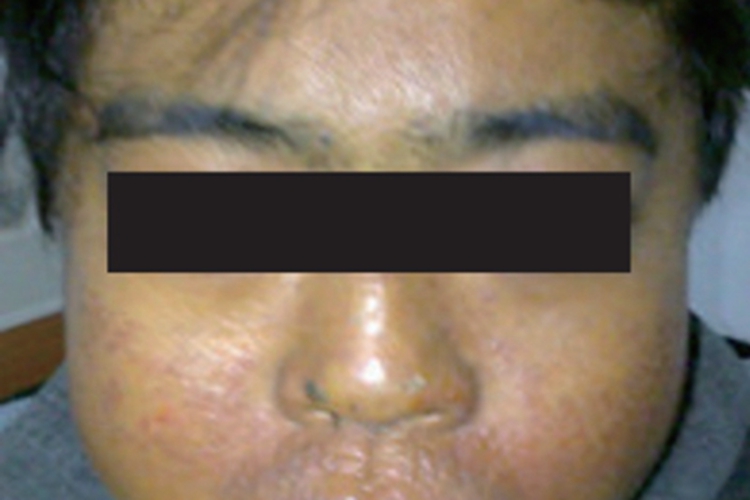 红细胞生成性原卟啉病面部粗糙图