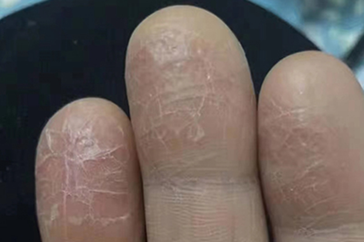 手部湿疹脱皮图