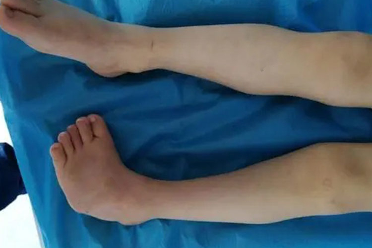 僵硬型足内翻图