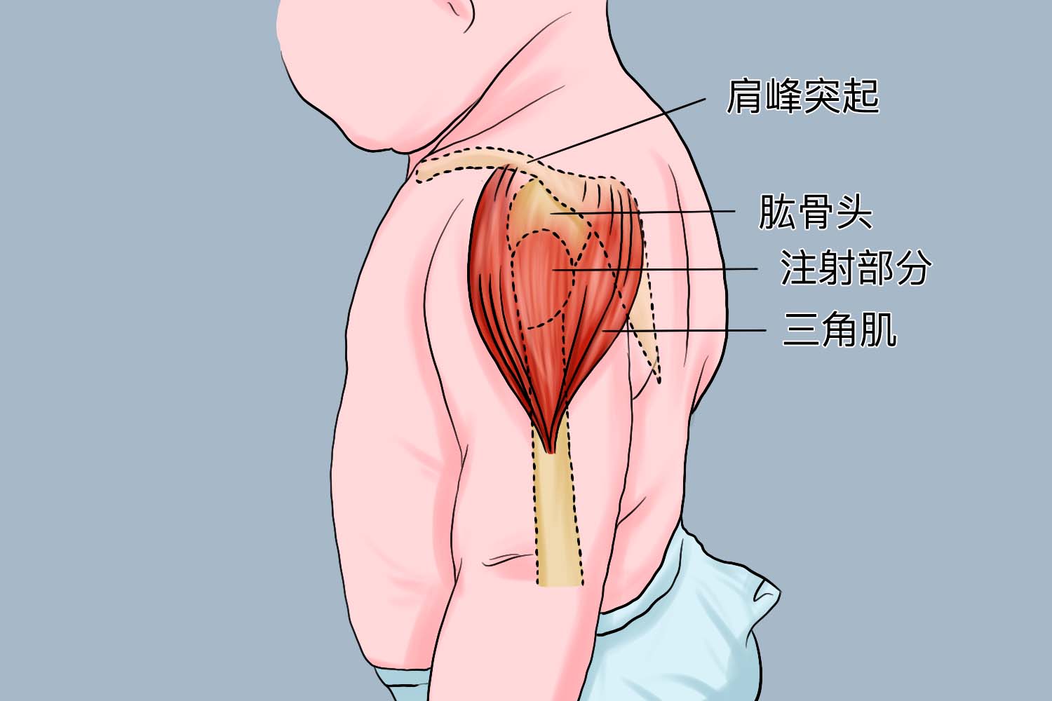新生儿上臂三角肌定位图