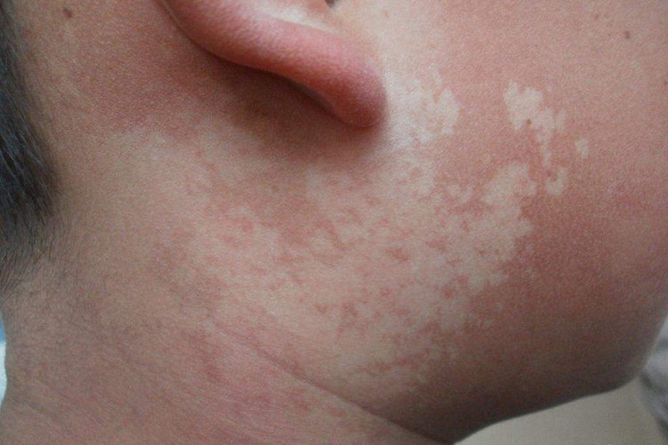 无色素痣白斑初期图