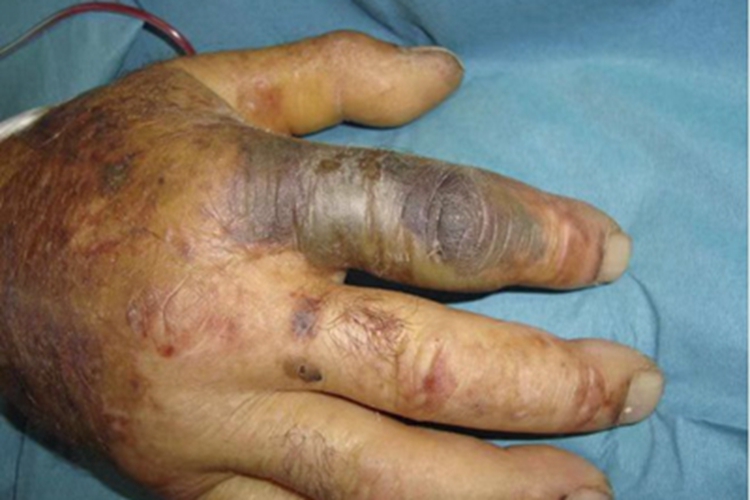 暴发性紫癜食指坏死手背紫红斑图 暴发性紫癜食指坏死手背紫红斑图